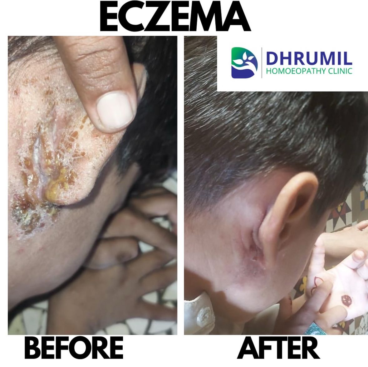 Eczema