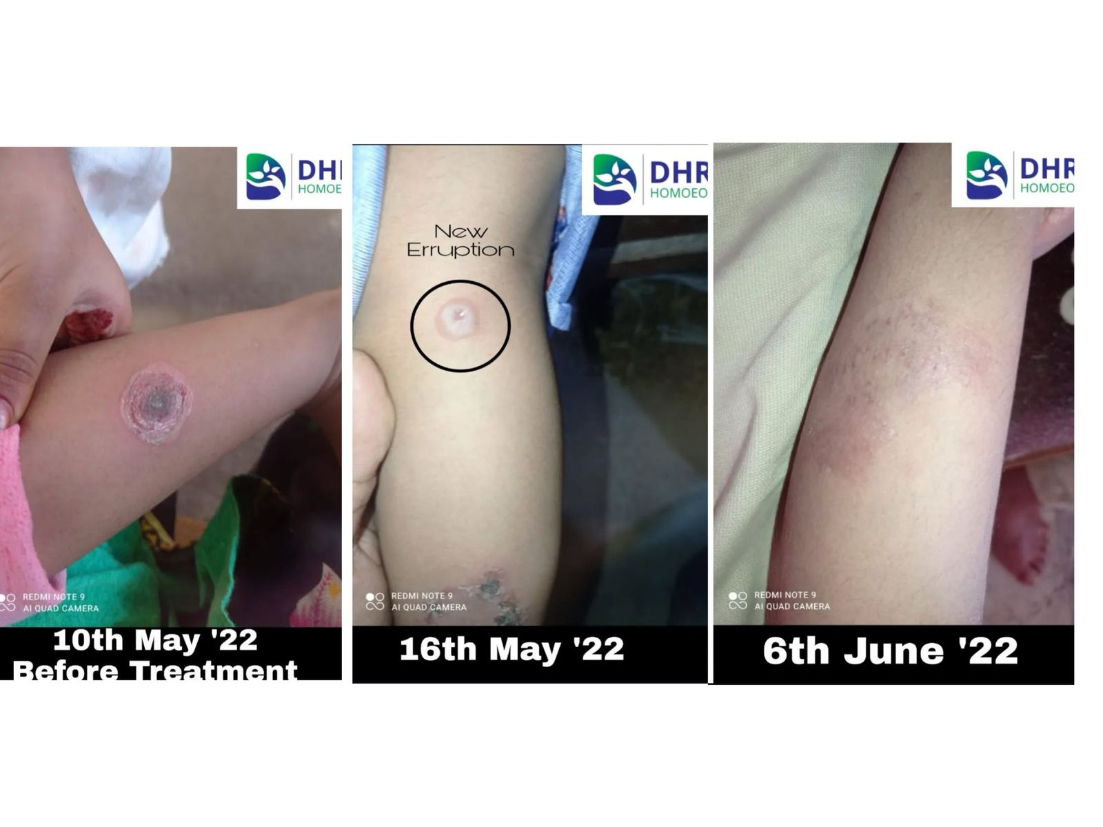 Skin Disorders